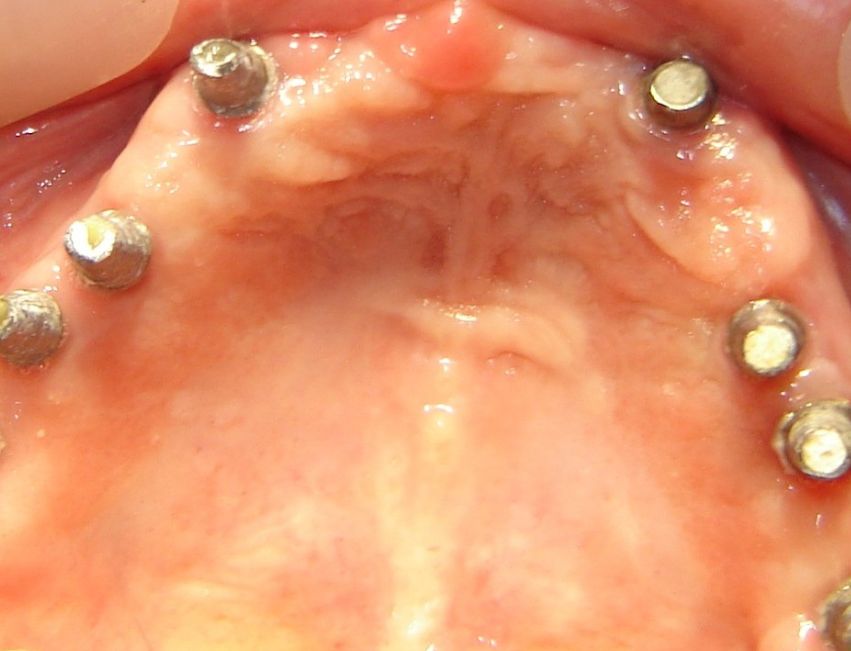 Rehabilitación compleja sobre implantes