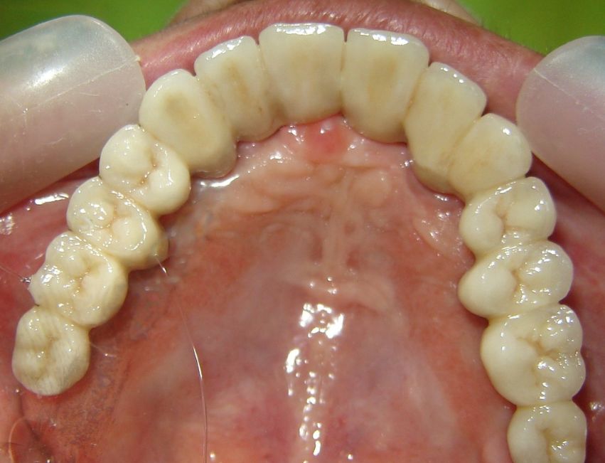 Rehabilitación compleja sobre implantes