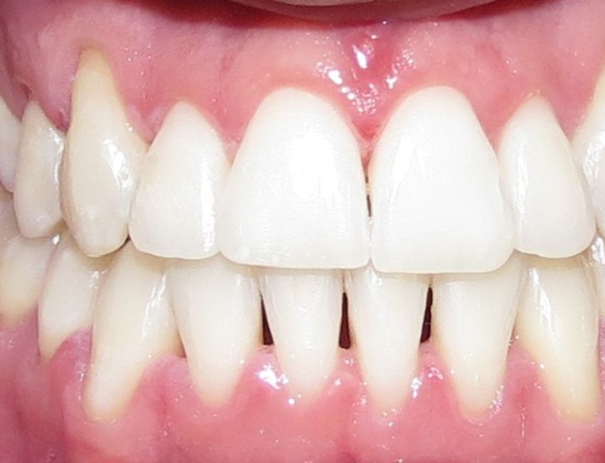 Blanqueamiento Dental Antes