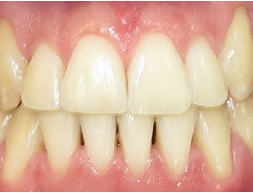 Blanqueamiento Dental Después